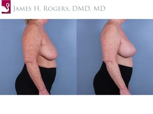 Breast Augmentation with Mastopexy (Breast Lift) Case #67790 (Image 3)