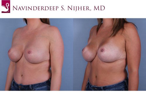 Breast Revisions Case #44752 (Image 2)