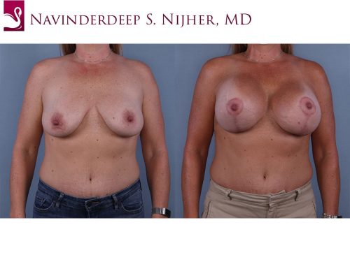 Breast Augmentation with Mastopexy (Breast Lift) Case #68348 (Image 1)