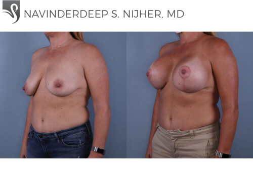Breast Augmentation with Mastopexy (Breast Lift) Case #68348 (Image 2)