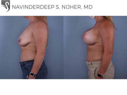 Breast Augmentation with Mastopexy (Breast Lift) Case #68348 (Image 3)