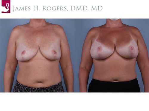Breast Augmentation Case #68529 (Image 1)