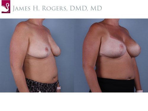 Breast Augmentation Case #68529 (Image 2)