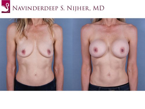 Breast Augmentation Case #68541 (Image 1)