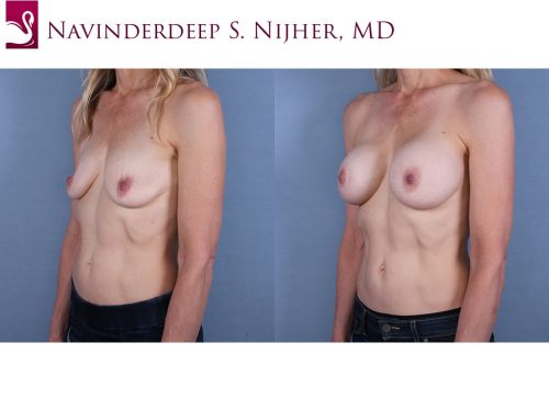 Breast Augmentation Case #68541 (Image 2)