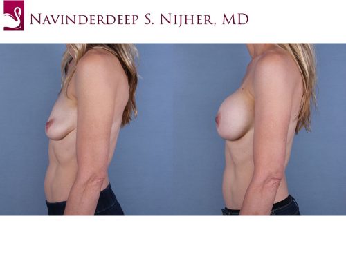 Breast Augmentation Case #68541 (Image 3)
