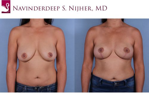 Breast Lift (Mastopexy) Case #68326 (Image 1)