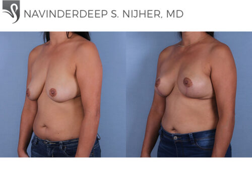 Breast Lift (Mastopexy) Case #68326 (Image 2)