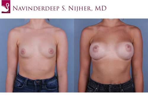 Breast Augmentation Case #68421 (Image 1)