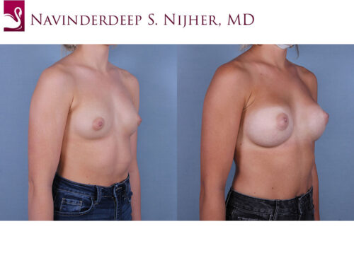 Breast Augmentation Case #68421 (Image 2)