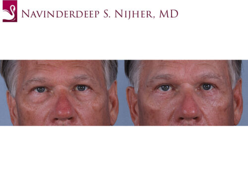 Eyelid Surgery Case #69282 (Image 1)