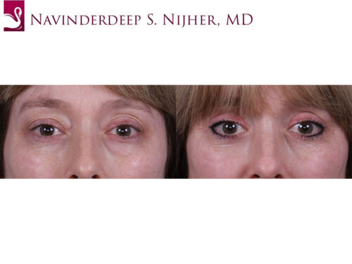 Eyelid Surgery Case #68687 (Image 1)
