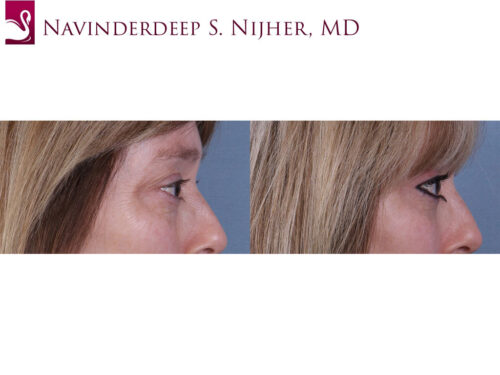 Eyelid Surgery Case #68687 (Image 3)