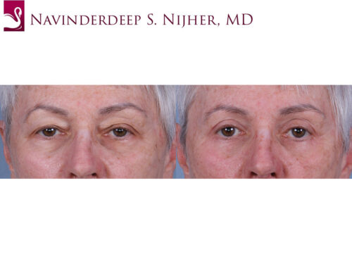 Eyelid Surgery Case #69842 (Image 1)
