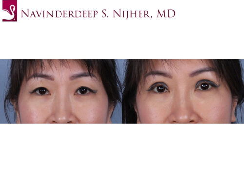 Eyelid Surgery Case #43478 (Image 1)