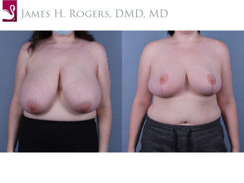 Female Breast Reduction Case #69328 (Image 1)