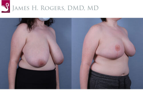 Female Breast Reduction Case #69328 (Image 2)