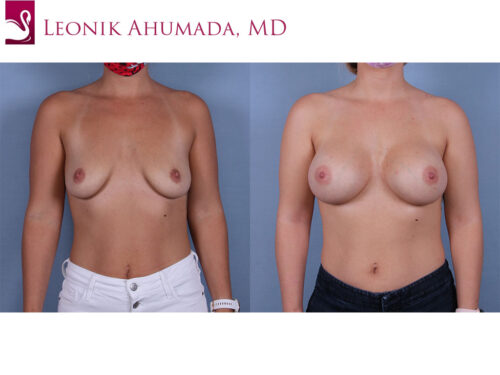 Breast Augmentation Case #70011 (Image 1)