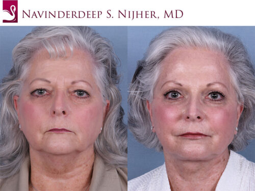 Before and after image of a real plastic surgery procedure performed by our surgeons.