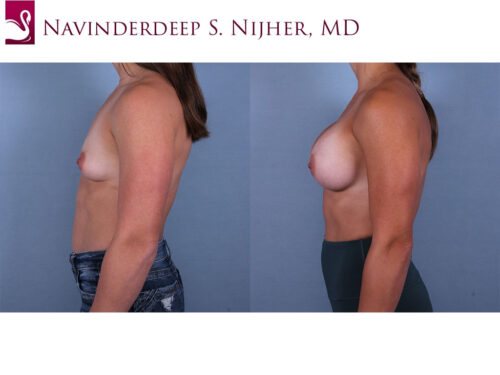 Breast Augmentation Case #68435 (Image 3)