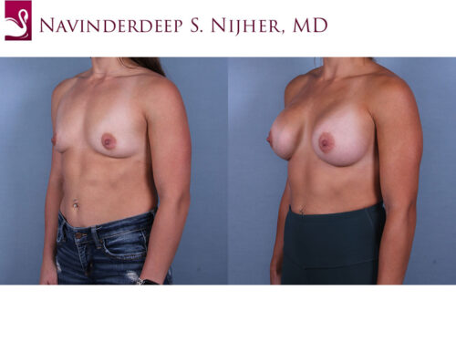 Breast Augmentation Case #68435 (Image 2)