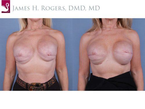 Breast Reconstruction Case #64488 (Image 1)