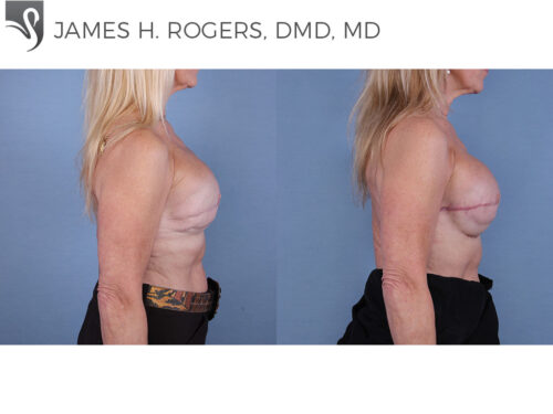 Breast Reconstruction Case #64488 (Image 3)