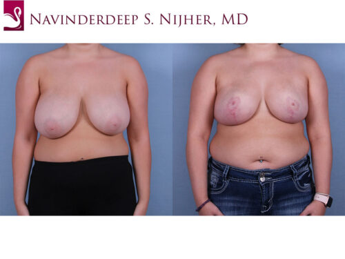 Female Breast Reduction Case #68049 (Image 1)