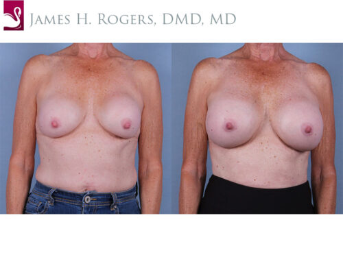 Breast Revisions Case #27898 (Image 1)