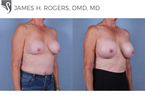 Breast Revisions Case #27898 (Image 2)