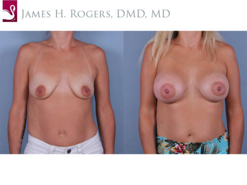 Breast Augmentation Case #71069 (Image 1)