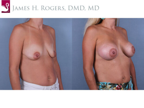 Breast Augmentation Case #71069 (Image 2)
