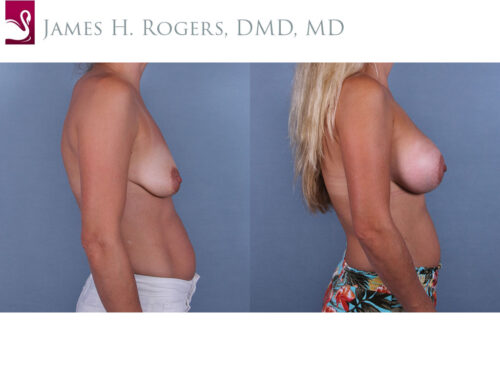 Breast Augmentation Case #71069 (Image 3)