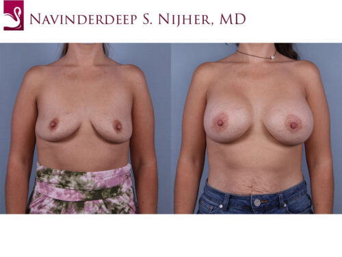 Breast Augmentation Case #71484 (Image 1)