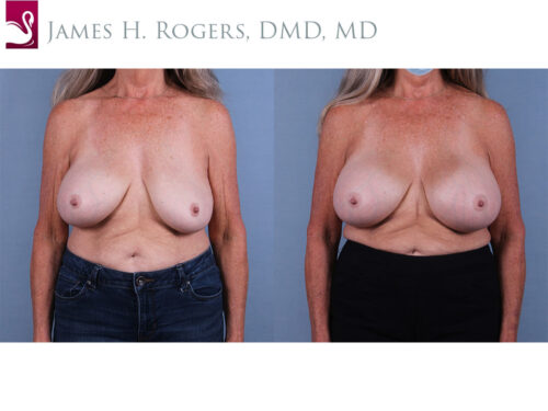 Breast Revisions Case #43316 (Image 1)