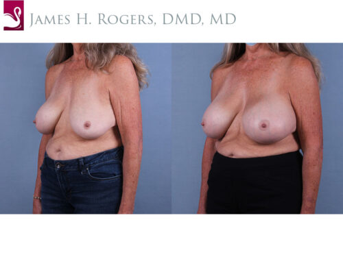 Breast Revisions Case #43316 (Image 2)