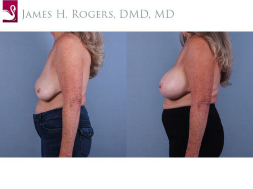 Breast Revisions Case #43316 (Image 3)