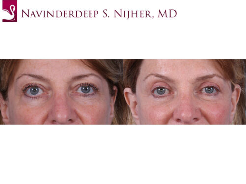 Eyelid Surgery Case #70790 (Image 1)