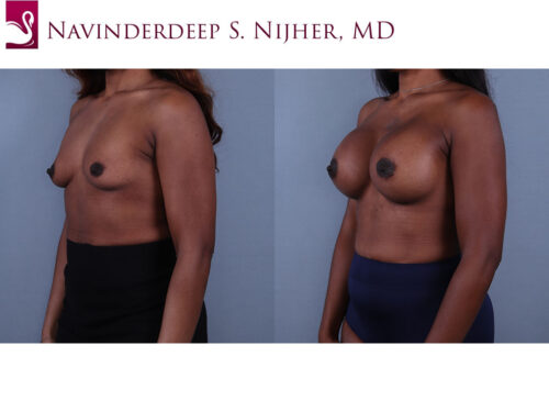 Breast Augmentation Case #71308 (Image 2)