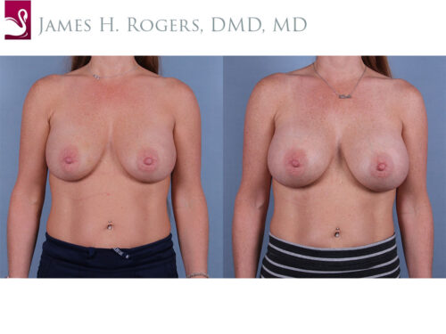 Breast Augmentation Case #24625 (Image 1)