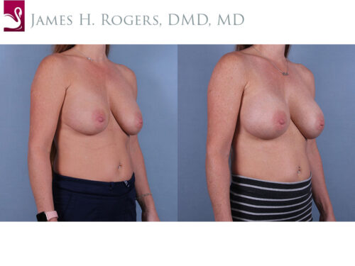 Breast Augmentation Case #24625 (Image 2)