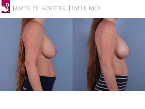 Breast Augmentation Case #24625 (Image 3)