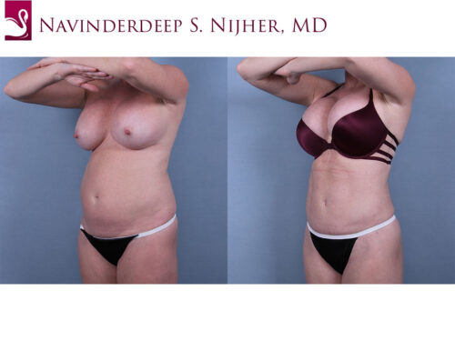 Liposuction Case #36852 (Image 2)