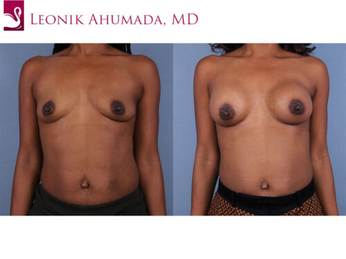 Breast Augmentation Case #47706 (Image 1)