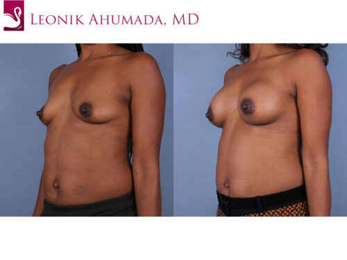 Breast Augmentation Case #47706 (Image 2)