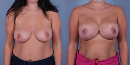Breast Augmentation with Mastopexy (Breast Lift) Case #55701 (Image 1)