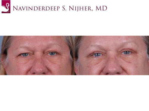 Eyelid Surgery Case #71857 (Image 1)