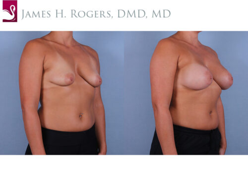Breast Augmentation Case #71928 (Image 2)