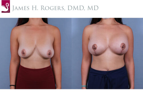 Breast Augmentation with Mastopexy (Breast Lift) Case #72887 (Image 1)