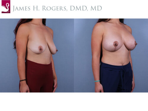 Breast Augmentation with Mastopexy (Breast Lift) Case #72887 (Image 2)
